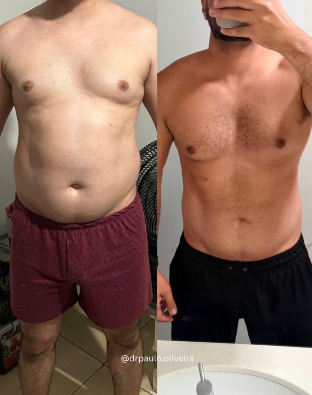 Paciente antes e depois do acompanhamento com Dr. Paulo Oliveira