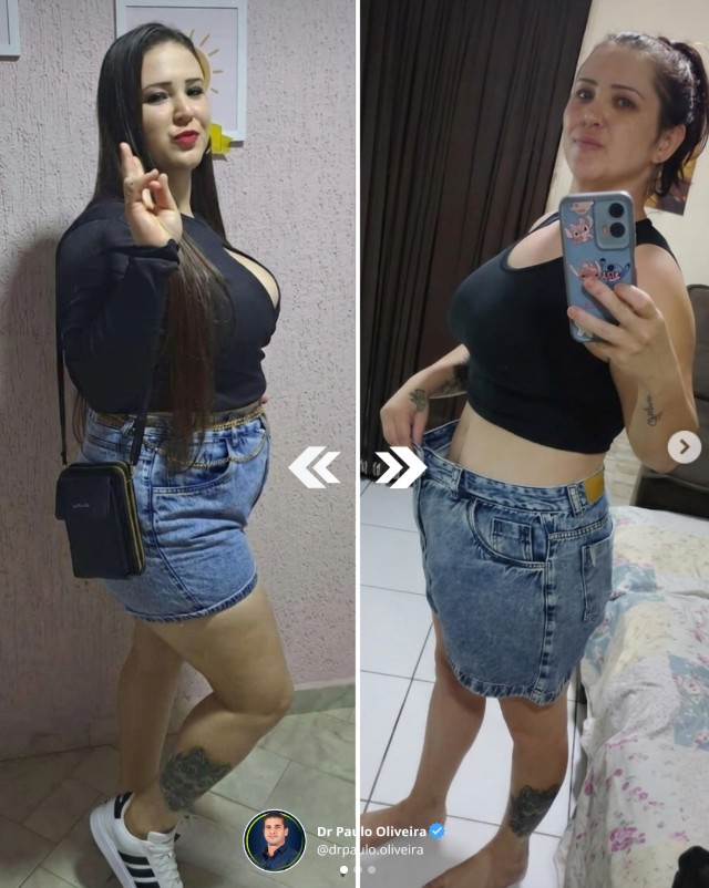 Paciente antes e depois do acompanhamento com Dr. Paulo Oliveira